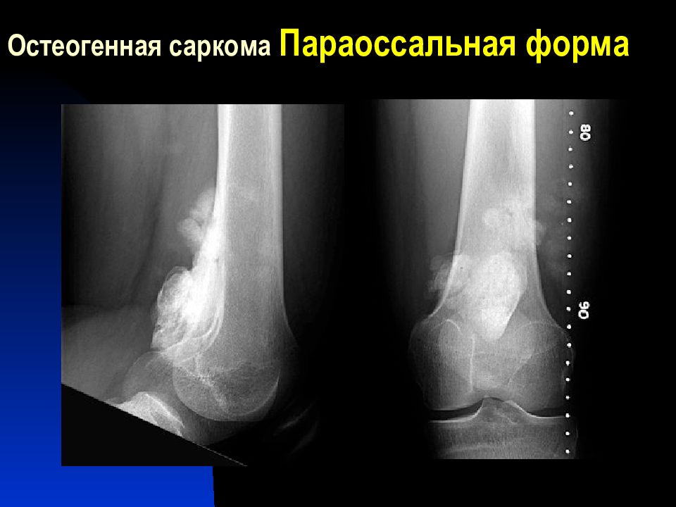 Саркома кости ноги. Остеогенная саркома бедренной кости рентген. Остеосаркома (остеогенная саркома). Параоссальная остеогенная саркома.