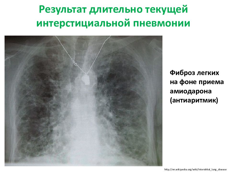 Корни малоструктурные легочный рисунок деформирован