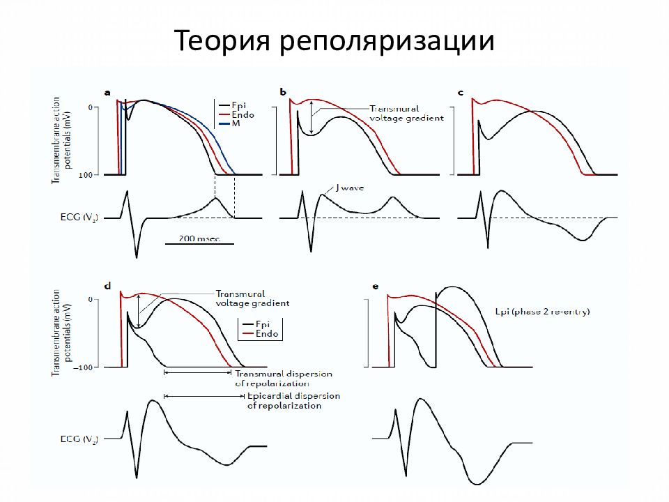 Синдром бругада на экг фото