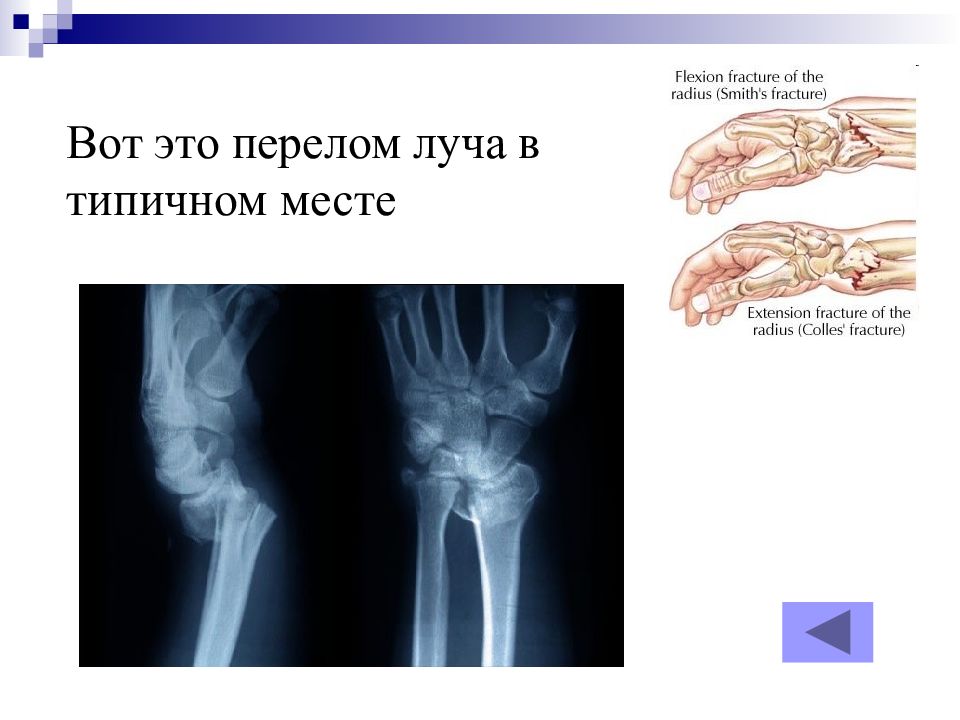 Место перелома слома 6 букв сканворд