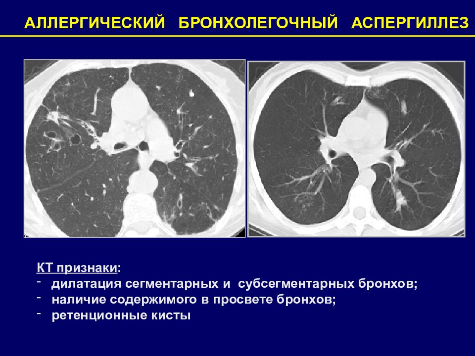 Аспергиллез легких презентация