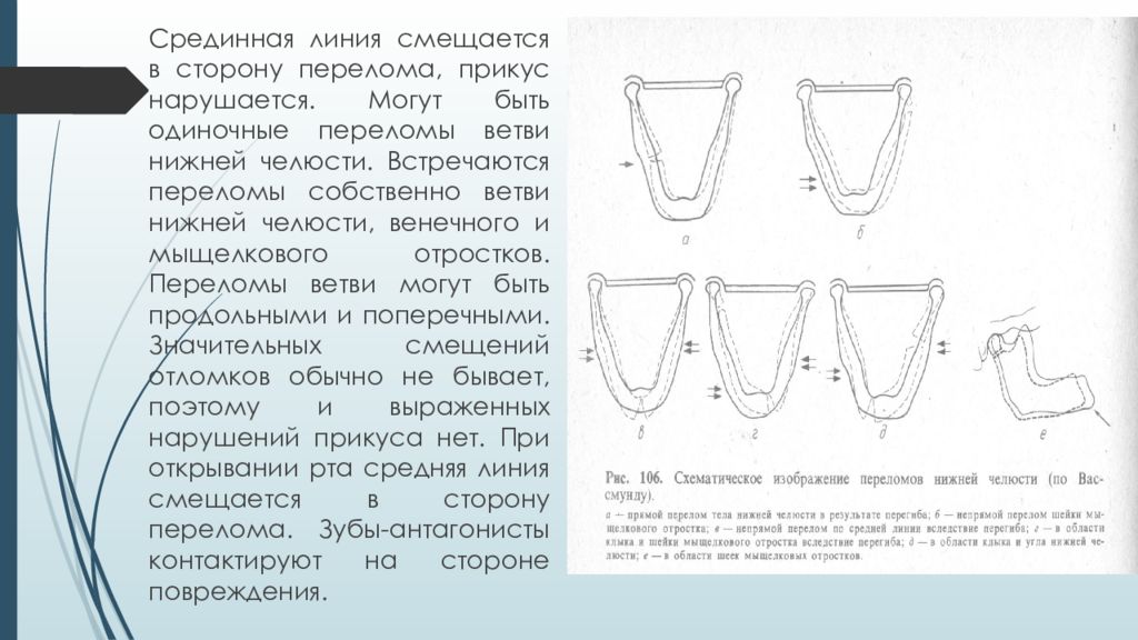 Методы временной и постоянной иммобилизации отломков челюстей презентация