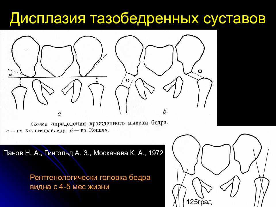 Схема хильгенрейнера тазобедренных суставов у детей