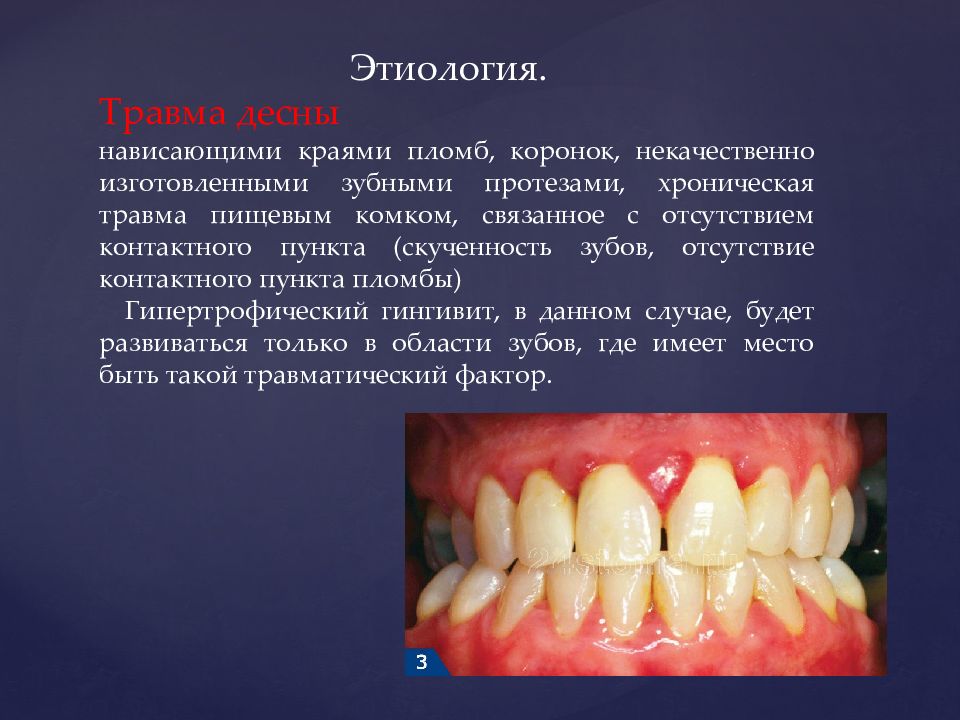 Гингивит гипертрофический презентация