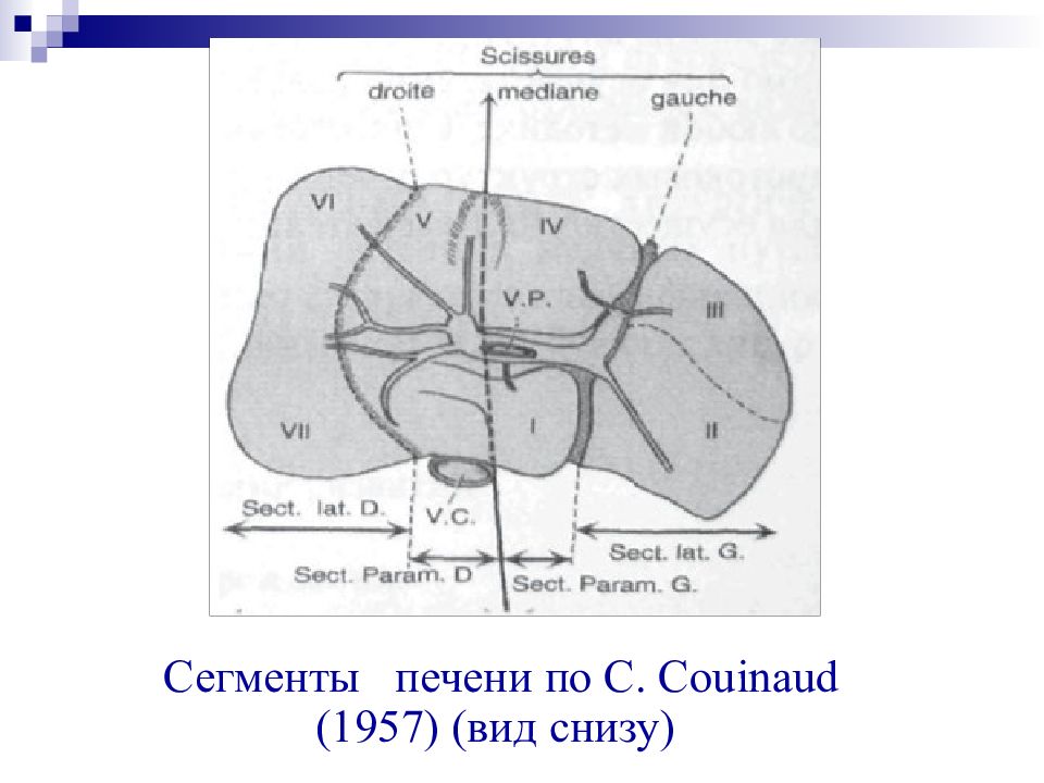 Сегменты печени мрт схема. Сегменты печени по Couinaud. Висцеральная поверхность печени сегменты. Сегменты печени по кт.