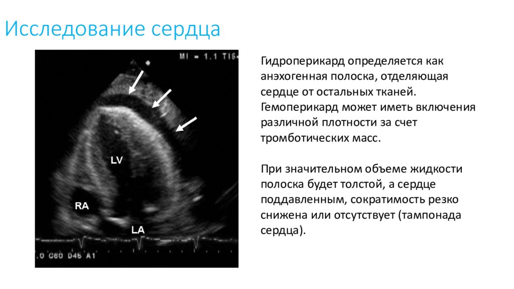 Гидроперикард. Гидроперикард по УЗИ сердца. Гидроперикард степени по УЗИ. УЗИ В неотложных состояниях. Ультразвуковая диагностика неотложных состояний.