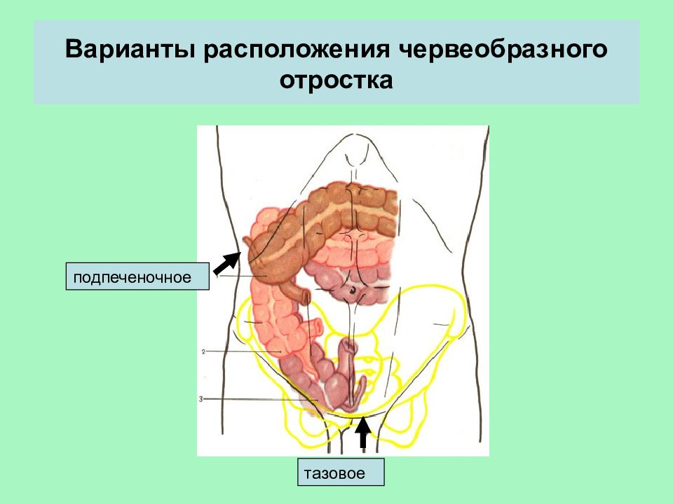 Варианты аппендицита. Расположение червеобразного отростка в брюшной полости. Червеобразный отросток слепой кишки. Ретроцекальный острый аппендицит. Подпеченочный острый аппендицит.