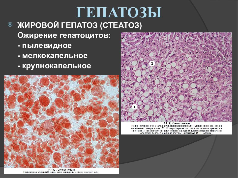 Жировой гепатоз печени презентация