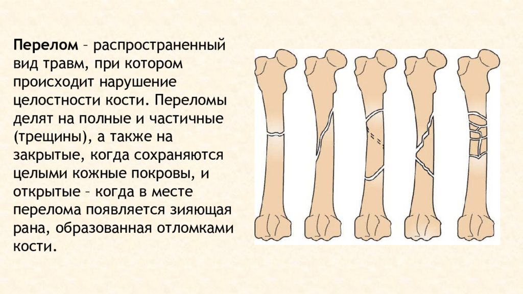 Переломы вывихи презентация