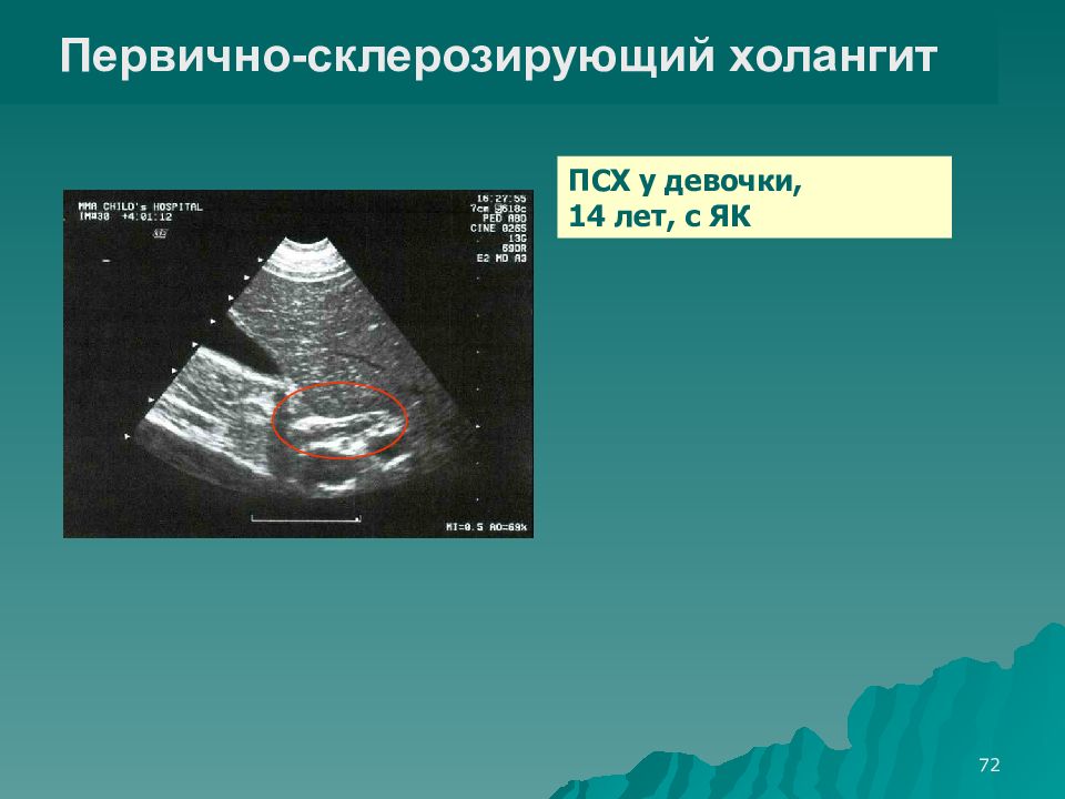 Склерозированный холангит. Первичный склерозирующий холангит УЗИ. Холангит УЗИ признаки. Первично склерозирующий холангит. Признаки хронического холангита на УЗИ.