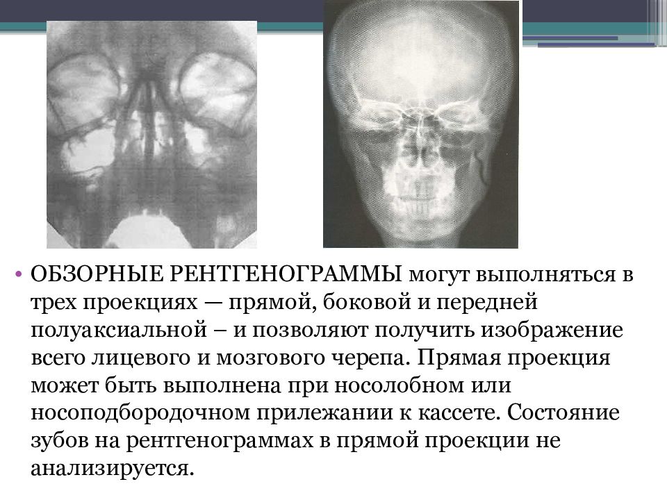 При рентгенографии костей носа в стандартной проекции получают изображение