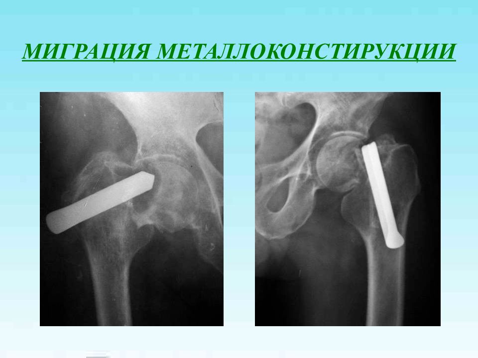 Проксимальный отдел бедренной кости. Перелом метафиза бедренной кости. Эпиметафиз бедренной кости. Перелом проксимального метафиза бедренной кости. Зоны роста проксимального отдела бедренной кости.