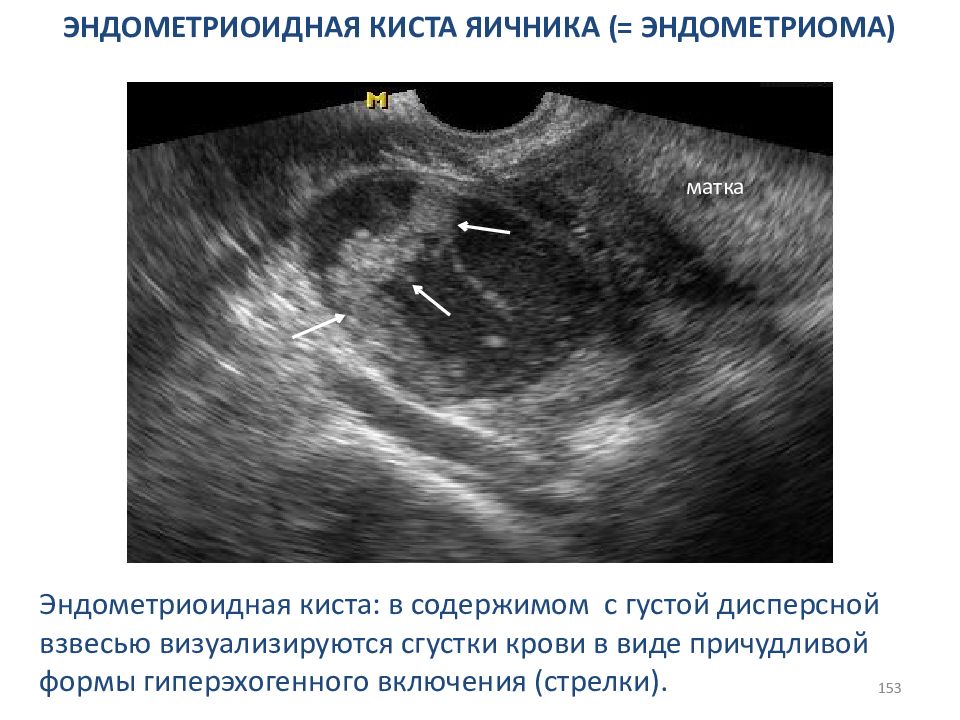 Тянет яичник при беременности на ранних. Эндометриозные кисты яичника. Эндометриоидные кисты яичников УЗИ. УЗИ картина эндометриоидной кисты яичника. Эндометриоидная киста яичника на УЗИ.