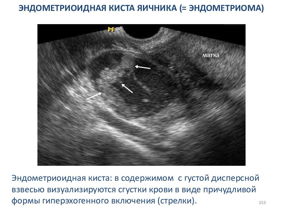 Задержка месячных при кисте яичника. Эндометриозные кисты яичника. Эндометриоидные кисты яичников УЗИ. УЗИ картина эндометриоидной кисты яичника. Эндометриоидная киста яичника на УЗИ.