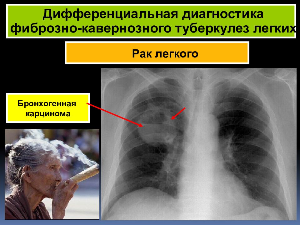 Пульмонология фтизиатрия. Кавернозный туберкулез рентген. Кавернозный туберкулез диагноз. Дифференцировать фиброзно-кавернозный туберкулез легких. Кавернозный туберкулез легких диагностика.