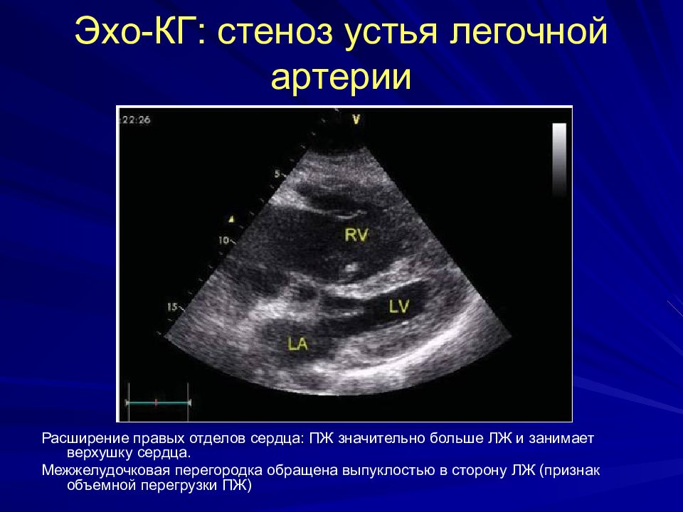 Эхо признаки. Стеноз клапана легочной артерии эхокардиография. Изолированный клапанный стеноз легочной артерии ЭХОКГ. Стеноз клапана легочной артерии ЭХОКГ. Стеноз легочного ствола ЭХОКГ.