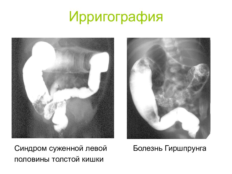 Хронический кишечный колостаз у детей презентация