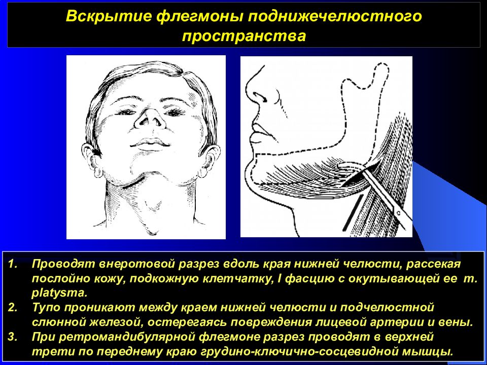Поднижнечелюстная флегмона. Вскрытие флегмон челюстно-лицевой области. Флегмон абсцессов и флегмон. Флегмона дна нижней челюсти.