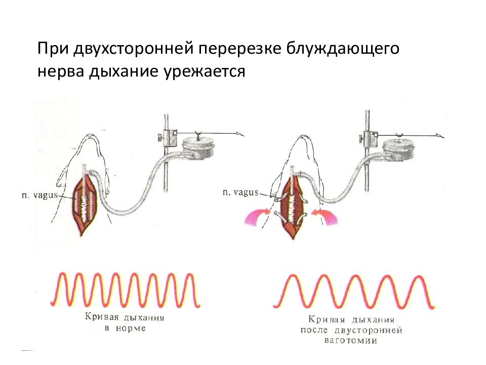 Стимулятор блуждающего нерва. При перерезке блуждающих нервов дыхание. Перерезка блуждающего нерва для дыхания. Электростимуляция блуждающего нерва.