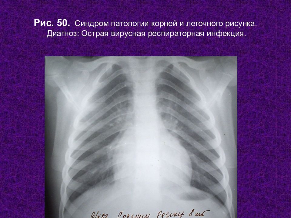 Синдром патология. Синдром патологии легочного рисунка. Синдром патологии корня легкого. Синдром патологии легочного рисунка рентген. Синдром патологии легочного корня.