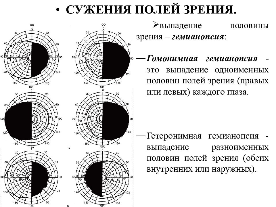 Увеличение полей зрения. Выпадение полей зрения периметрия. Гомонимная гемианопсия поля зрения. Скотома это выпадение поля зрения в. Выпадение полей зрения неврология.