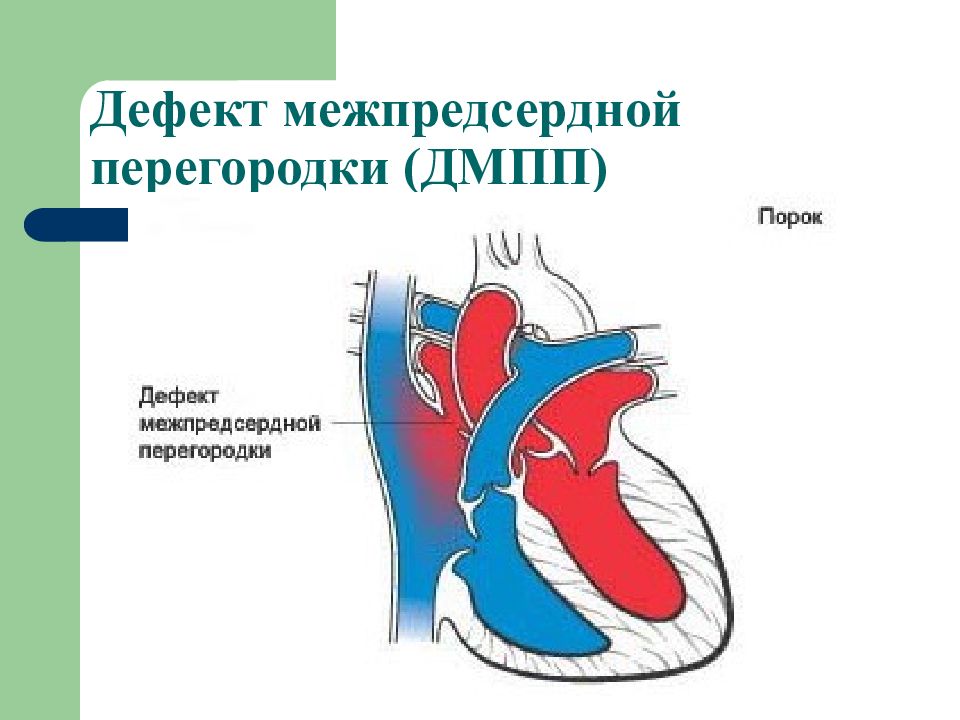 Перегородки сердца