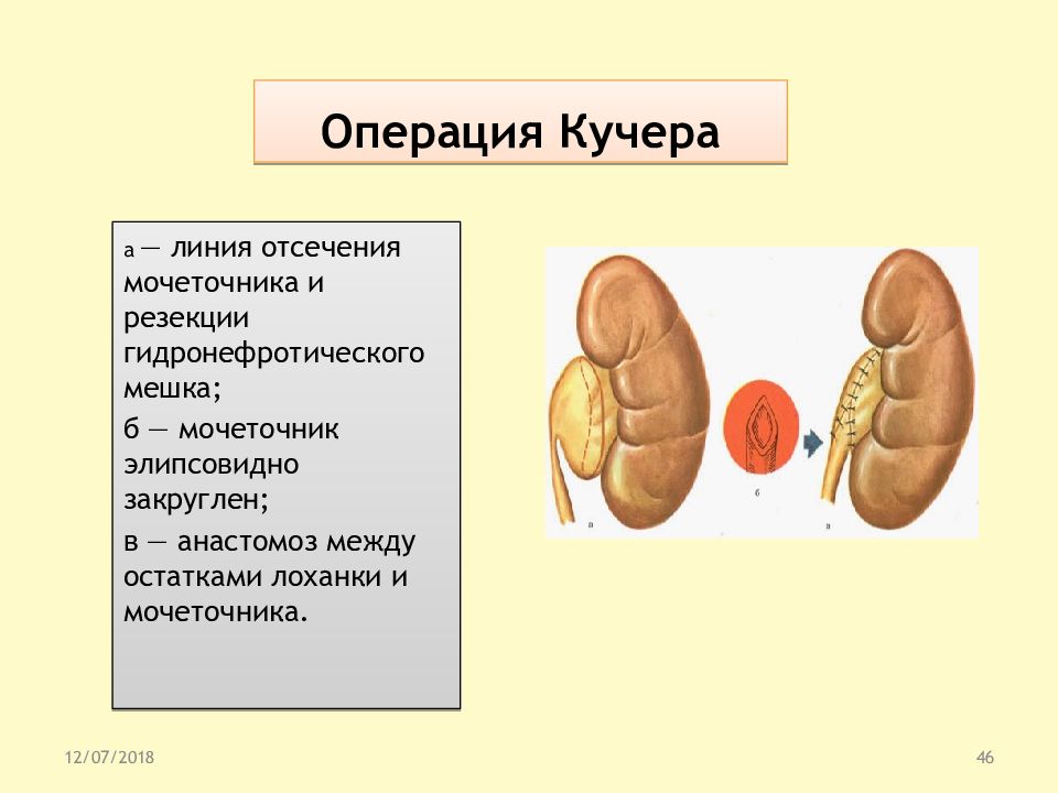 Операция андерсона. Операция Андерсен Кучера гидронефроз. Операция Андерсена гидронефроз. Операция Андерсена-Хайнса. Операи Андерсона Кучеры.