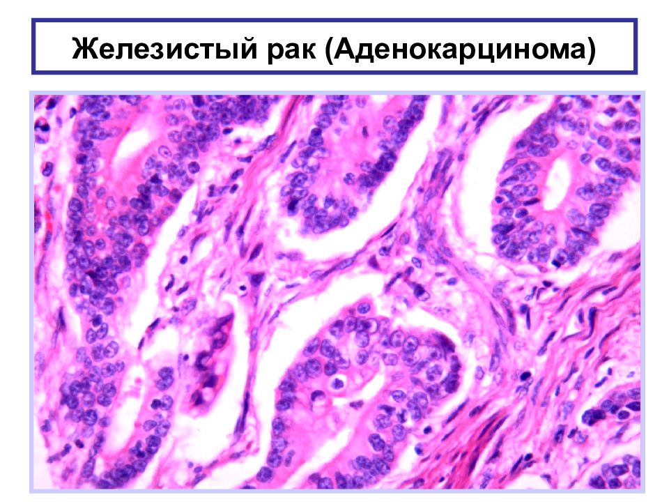 Микропрепарат аденокарцинома желудка рисунок