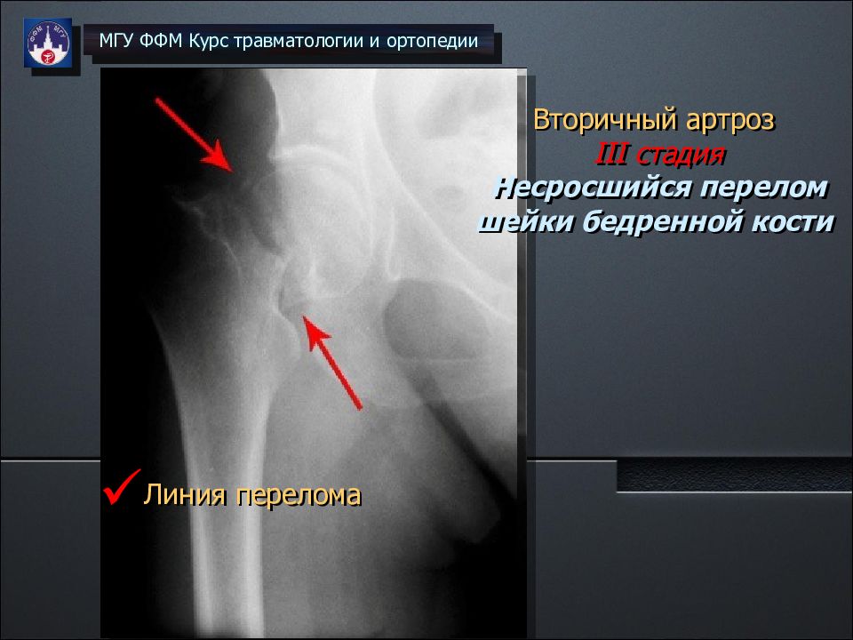 Асептический некроз кости. Асептический некроз головки большеберцовой кости. Асептический некроз большеберцовой кости кт. Идиопатический асептический некроз кости. Идиопатический асептический некроз кости тазобедренного сустава.