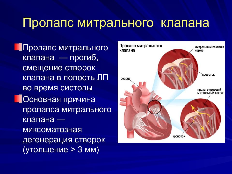 Пролапс сердца. Створки митрального клапана сердца. Пролапс передней створки митрального клапана 3ст. Пролапс нейтрального клапана сердца 1 степени. Функциональная кардиопатия пролапс митрального клапана.