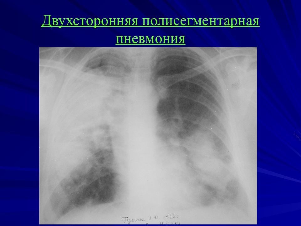 Двухсторонняя пневмония. Двусторонняя пневмония рентген. Двухсторонняя полисегментарная пневмония кт1. Рентген легких полисегментарная пневмония. Внебольничная двусторонняя полисегментарная пневмония.