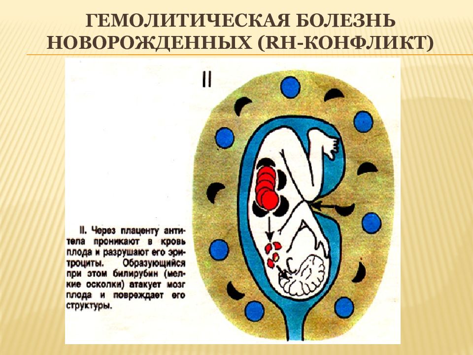 Гемолитическая болезнь плода презентация