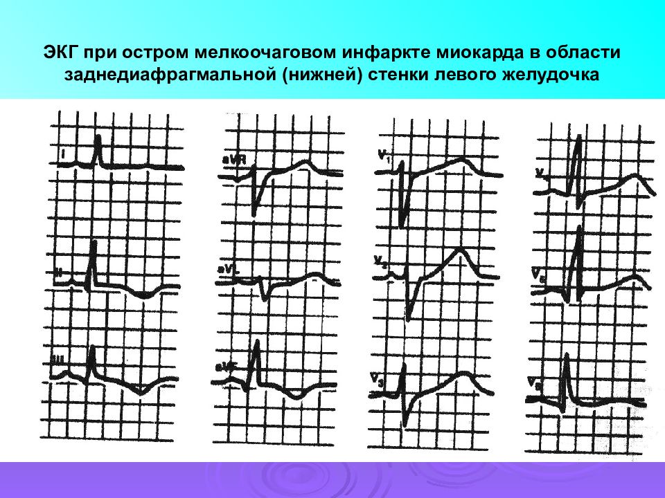 Как выглядит инфаркт на экг картинки и фото