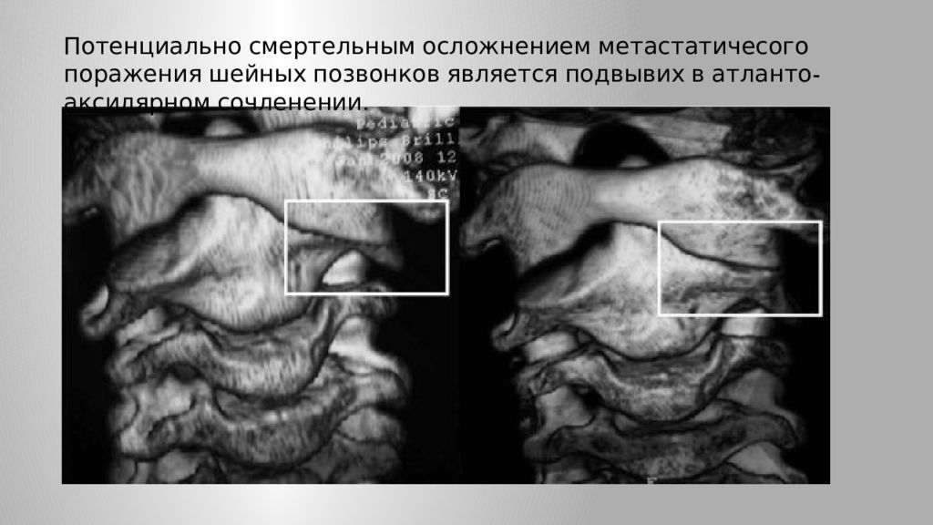 Подвывих позвонка. Подвывих с1 шейного позвонка рентген. Ротационный подвывих шейного позвонка. Подвывих атланто-аксиального сочленения кт. Ротационный подвывих Атланта на кт.