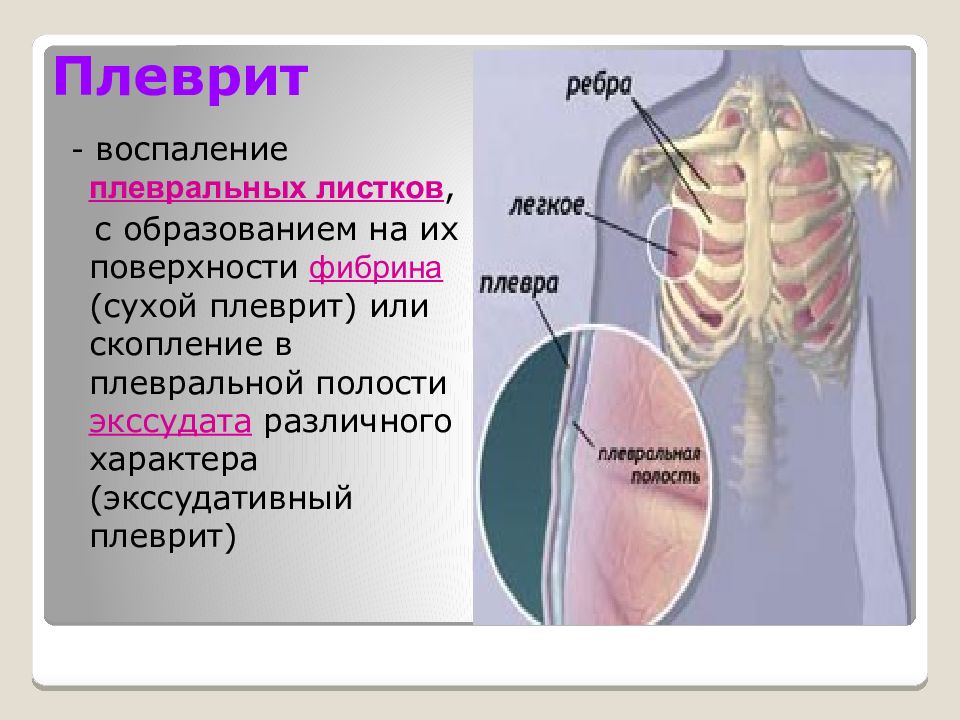 Презентация на тему плеврит