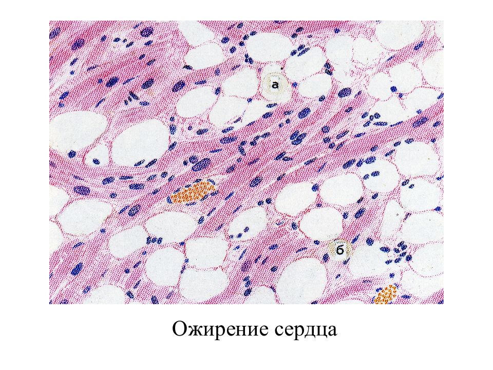 Жировая дистрофия миокарда. Ожирение сердца патологическая анатомия. Ожирение сердца патанатомия. Ожирение сердца патологическая анатомия макропрепарат. Жировая дистрофия миокарда патанатомия.