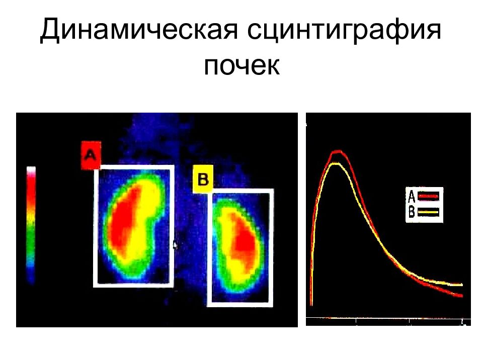 Что такое сцинтиграфия