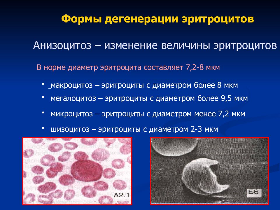 Анизоцитоз эритроцитов. Причина микроцитоза эритроцитов. Макроцитарный анизоцитоз.