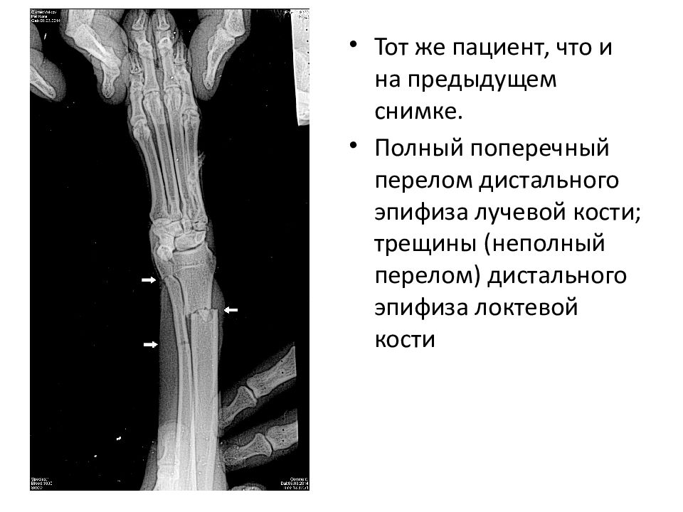Эпифиз кости перелом. Перелом эпифиза локтевой кости. Перелом поперечный эпифиза локтевой кости. Перелом эпифиза лучевой кости рентген. Перелом лучевой кости у коровы.