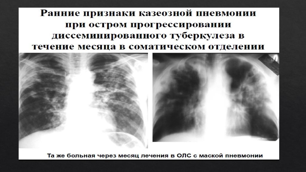 Казеозная пневмония фото