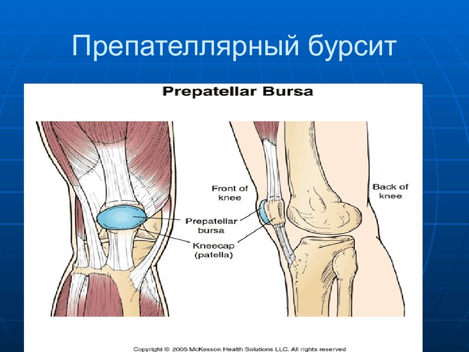 Препателярный бурсит. Препателлярный бурсит препателлярный. Препателлярная сумка анатомия. Препателлярная сумка коленного сустава. Супрапателлярный бурсит Гнойный.