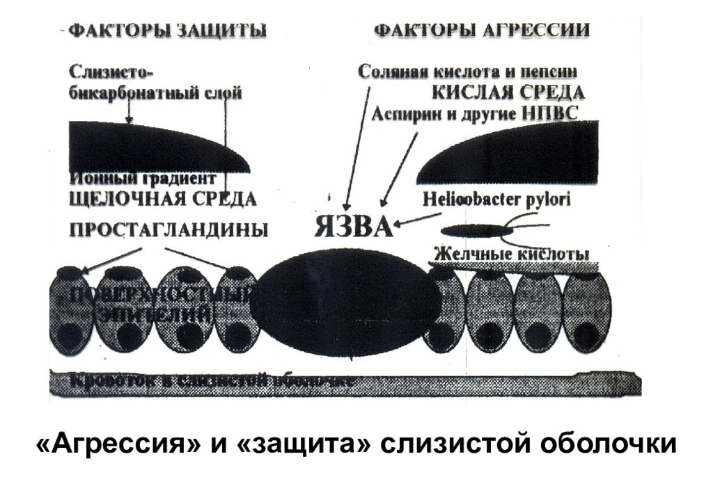 Фактор защиты слизистых оболочек. Факторы защиты слизистой оболочки. Факторы агрессии и факторы защиты слизистой оболочки. Хронический гастрит факторы агрессии и защиты. Язва факторы агрессии и защиты.