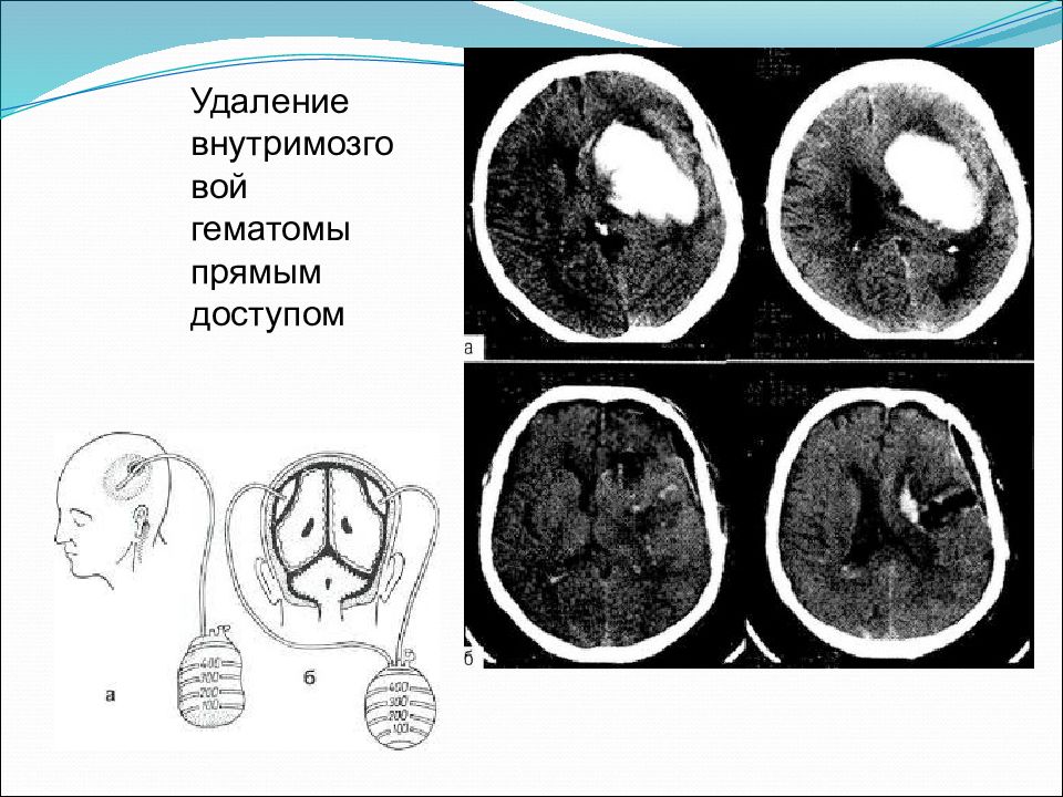 Формирование гематомы. Классификация гематом при ЧМТ. Объем гематомы головного мозга. Гематома в головном мозге.