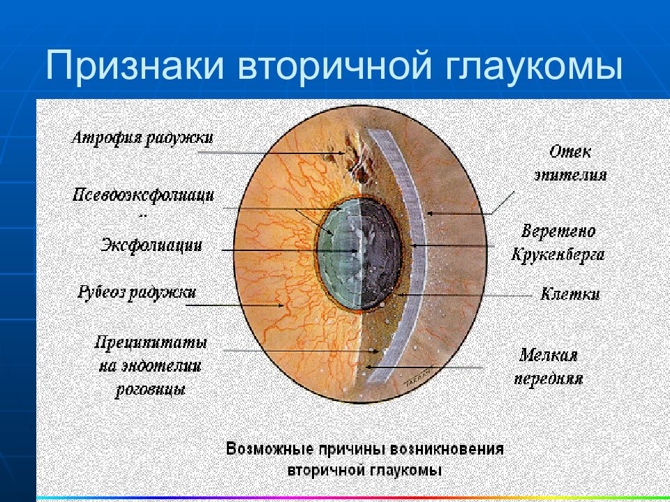 Признаки глаукомы. Вторичная врожденная глаукома. Пигментная открытоугольная глаукома. Первичная и вторичная глаукома.