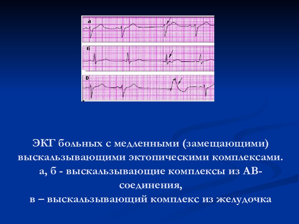 Комплекс экг. Медленные выскальзывающие комплексы на ЭКГ. Выскальзывающий желудочковый ритм на ЭКГ. Выскальзывающие желудочковые комплексы на ЭКГ. Выскальзывающие комплексы из АВ соединения на ЭКГ.