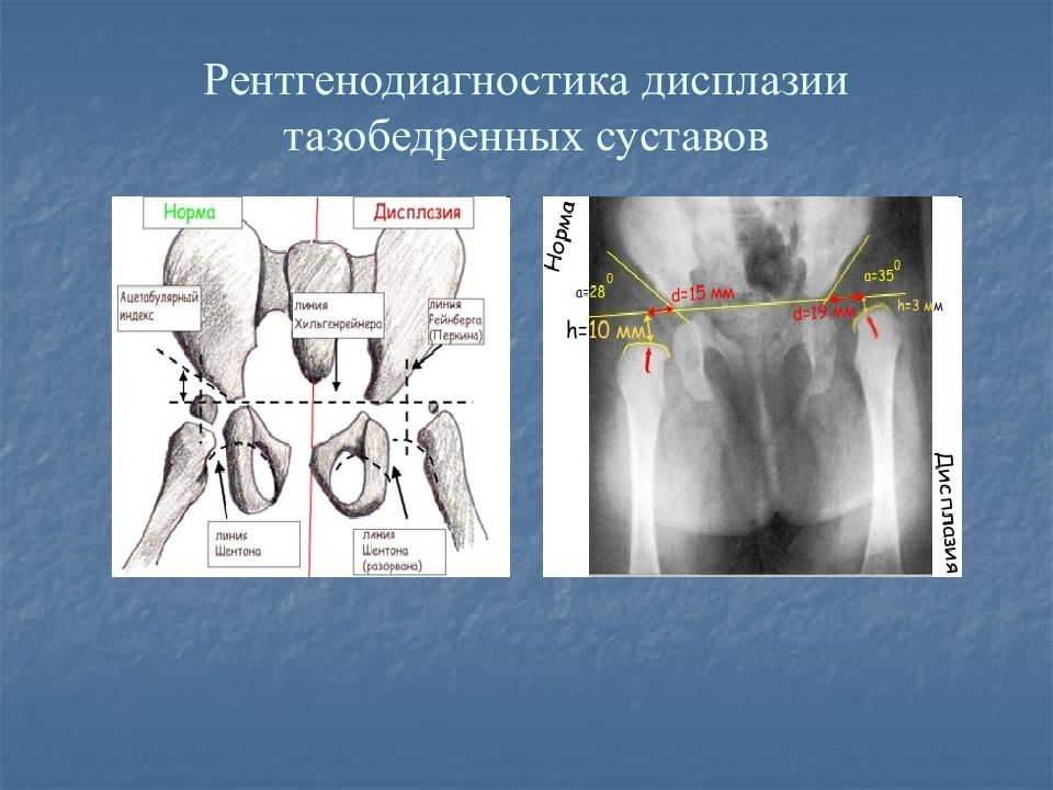 Ацетабулярный угол у детей