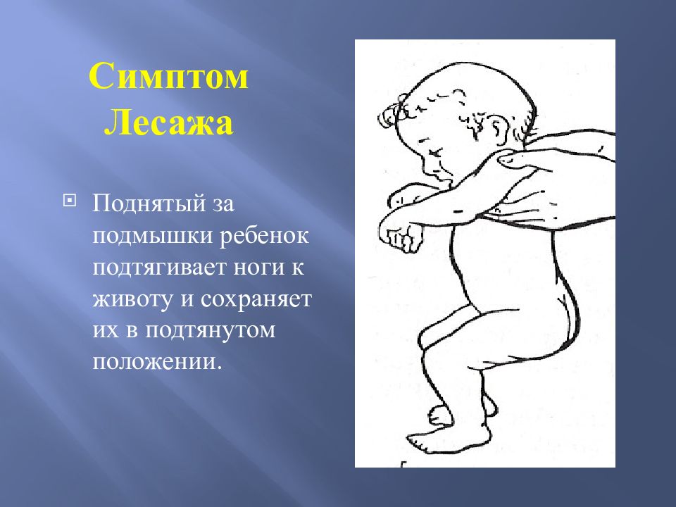 Поднимает малыша. Симптом подвешивания Лесажа у детей. Симптом симптом подвешивания Лесажа. Симптом Лесажа менингеальный. Симптом Лесажа при менингите.