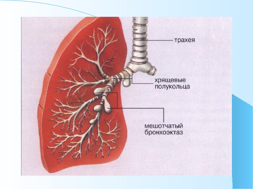 Бронхоэктатическая болезнь у детей презентация