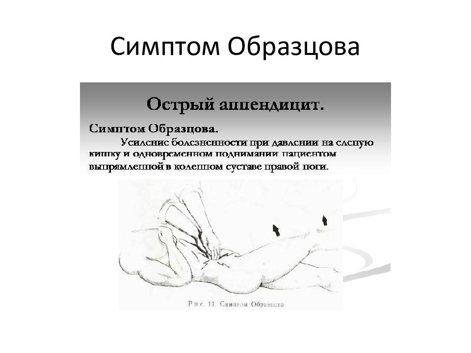 Наиболее типичная клиническая картина острого аппендицита развивается