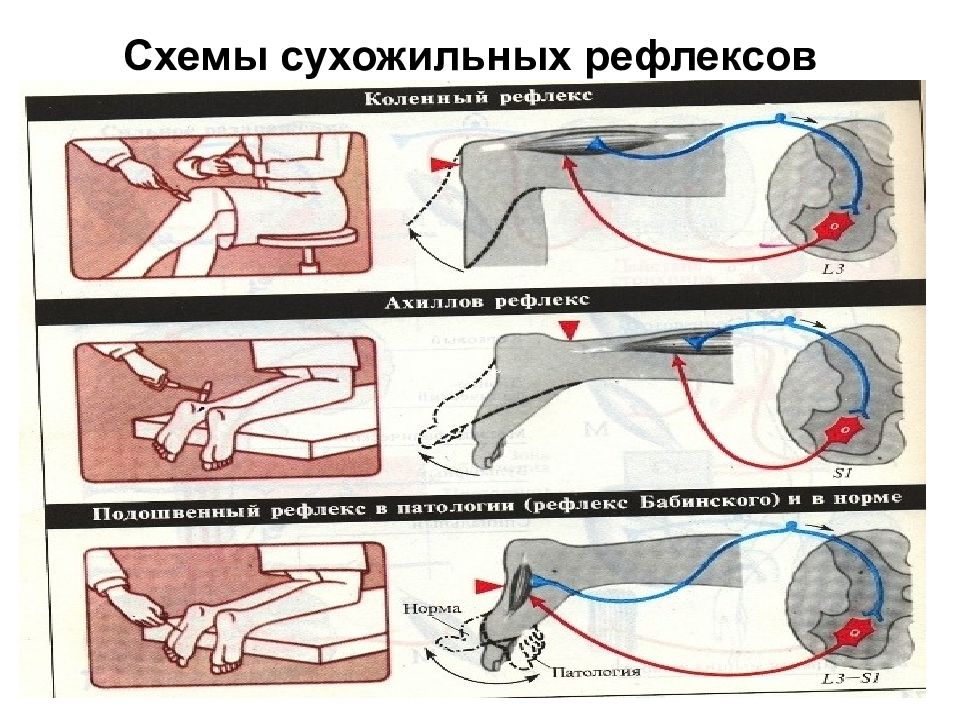 Схема рефлекторной дуги ахиллова рефлекса